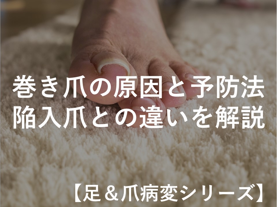 巻き爪の原因と予防法、陥入爪との違いを解説